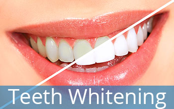teeth whitening columbia south carolina