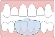 NTI Splint for TMJ treatment