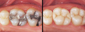tooth colored fillings columbia