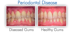 gum disease treatment columbia SC