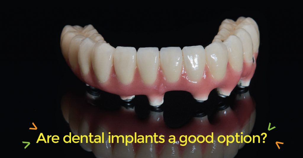 dental implants columbia sc