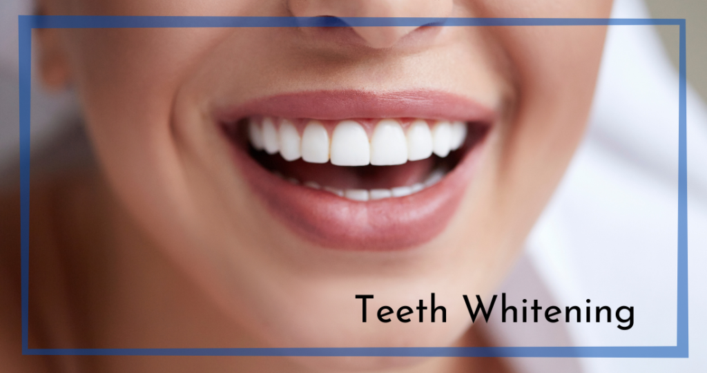 Teeth Whitening Columbia SC